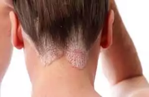 psoriasis-on-the-hairline-and-on-the-scalp