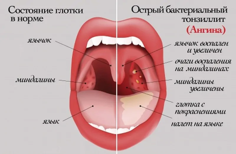 Можно ли лечить зубы, если болит горло?